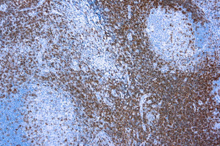 Immunohistochemical staining of CD3, T Cell  of human FFPE tissue followed by incubation with HRP labeled secondary and development with DAB substrate.