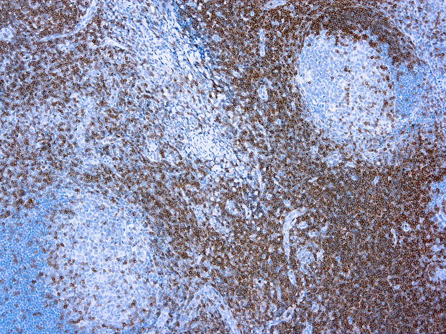 Immunohistochemical staining of CD3, T Cell  of human FFPE tissue followed by incubation with HRP labeled secondary and development with DAB substrate.