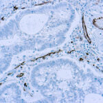 Immunohistochemical staining of CD31  of human FFPE tissue followed by incubation with HRP labeled secondary and development with DAB substrate.