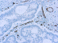 Immunohistochemical staining of CD31  of human FFPE tissue followed by incubation with HRP labeled secondary and development with DAB substrate.