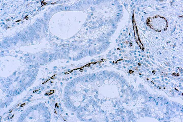 Immunohistochemical staining of CD31  of human FFPE tissue followed by incubation with HRP labeled secondary and development with DAB substrate.