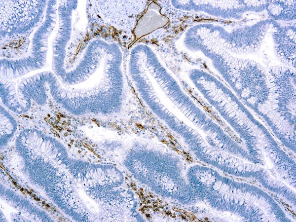 Immunohistochemical staining of CD31, Endothelial Cell  of human FFPE tissue followed by incubation with HRP labeled secondary and development with DAB substrate.