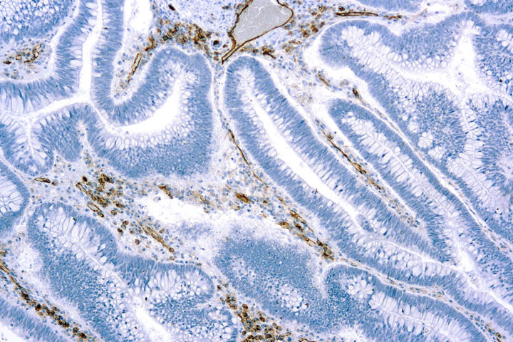 Immunohistochemical staining of CD31, Endothelial Cell  of human FFPE tissue followed by incubation with HRP labeled secondary and development with DAB substrate.