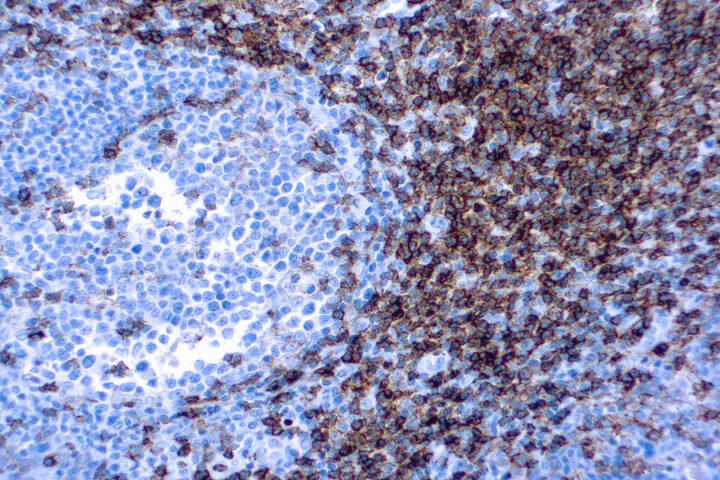 Immunohistochemical staining of CD4  of human FFPE tissue followed by incubation with HRP labeled secondary and development with DAB substrate.