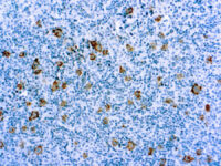 Immunohistochemical staining of CD30  of human FFPE tissue followed by incubation with HRP labeled secondary and development with DAB substrate.