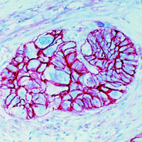 Immunohistochemical staining of CD44/HCAM  of human FFPE tissue followed by incubation with HRP labeled secondary and development with DAB substrate.