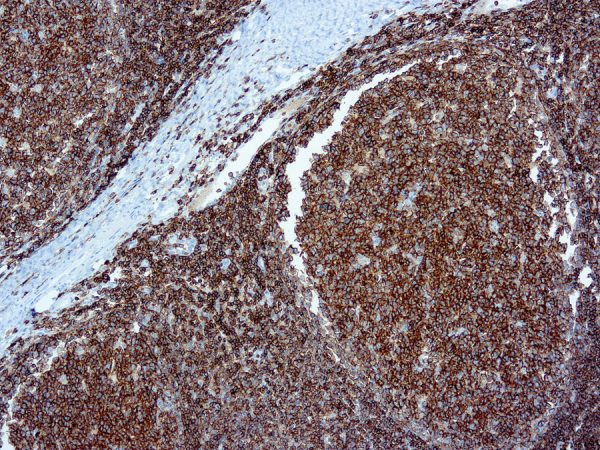 Immunohistochemical staining of CD45  of human FFPE tissue followed by incubation with HRP labeled secondary and development with DAB substrate.