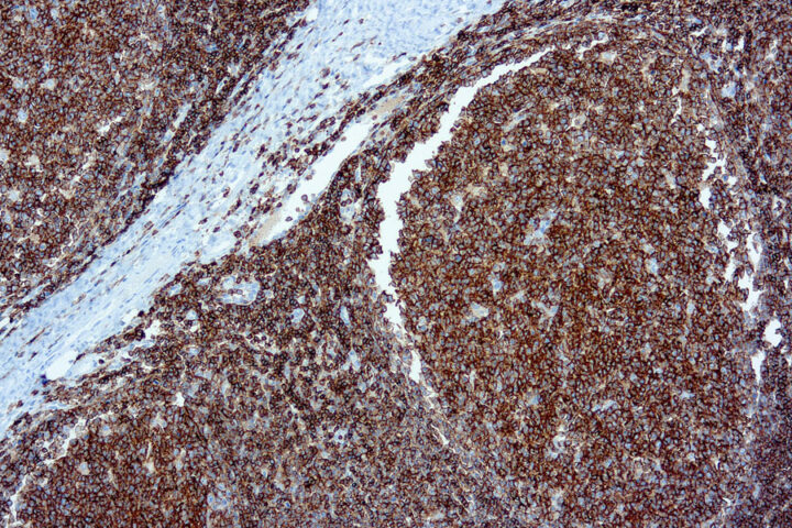 Immunohistochemical staining of CD45  of human FFPE tissue followed by incubation with HRP labeled secondary and development with DAB substrate.