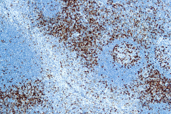 Immunohistochemical staining of CD45RO, T Cell  of human FFPE tissue followed by incubation with HRP labeled secondary and development with DAB substrate.