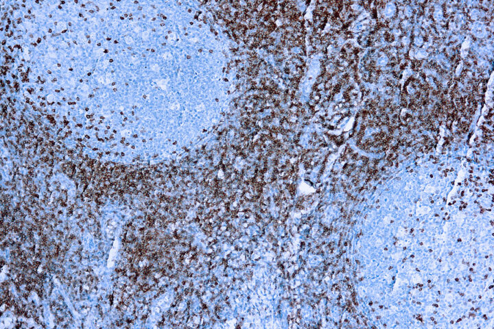 Immunohistochemical staining of CD5  of human FFPE tissue followed by incubation with HRP labeled secondary and development with DAB substrate.