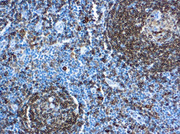 Immunohistochemical staining of CD74, Lymphoid Marker  of human FFPE tissue followed by incubation with HRP labeled secondary and development with DAB substrate.