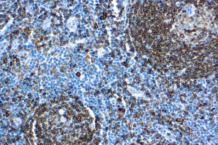 Immunohistochemical staining of CD74, Lymphoid Marker  of human FFPE tissue followed by incubation with HRP labeled secondary and development with DAB substrate.