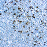 Immunohistochemical staining of CD8  of human FFPE tissue followed by incubation with HRP labeled secondary and development with DAB substrate.