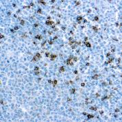 Immunohistochemical staining of CD8  of human FFPE tissue followed by incubation with HRP labeled secondary and development with DAB substrate.