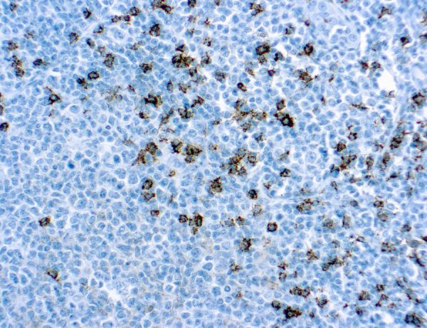 Immunohistochemical staining of CD8  of human FFPE tissue followed by incubation with HRP labeled secondary and development with DAB substrate.