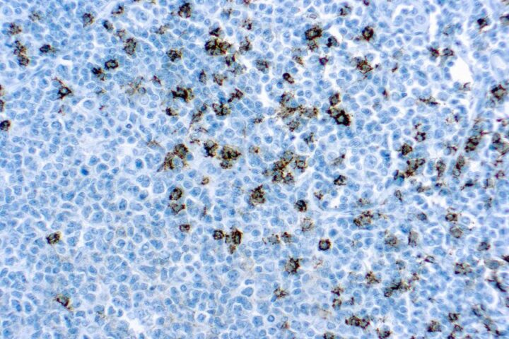 Immunohistochemical staining of CD8  of human FFPE tissue followed by incubation with HRP labeled secondary and development with DAB substrate.