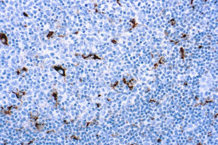 Immunohistochemical staining of CD68, Macrophage  of human FFPE tissue followed by incubation with HRP labeled secondary and development with DAB substrate.