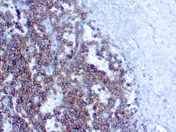 Immunohistochemical staining of CD99/MIC2, Ewing's Sarcoma Marker  of human FFPE tissue followed by incubation with HRP labeled secondary and development with DAB substrate.