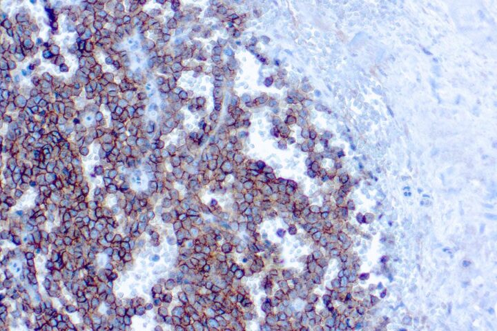 Immunohistochemical staining of CD99/MIC2, Ewing's Sarcoma Marker  of human FFPE tissue followed by incubation with HRP labeled secondary and development with DAB substrate.