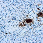 Immunohistochemical staining of CD61/Platelet Glycoprotein IIIa  of human FFPE tissue followed by incubation with HRP labeled secondary and development with DAB substrate.