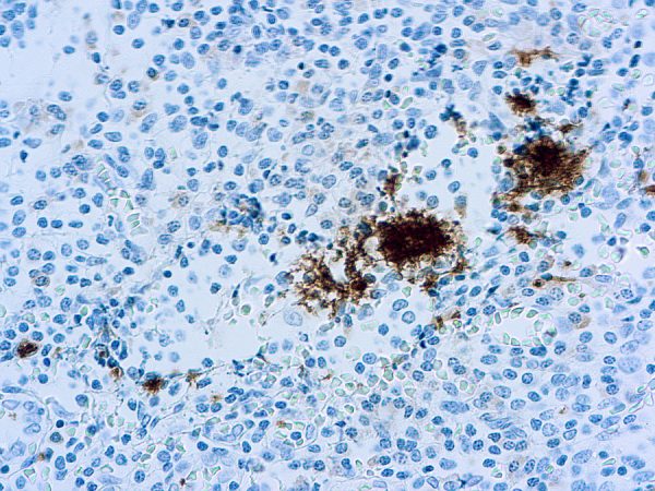 Immunohistochemical staining of CD61/Platelet Glycoprotein IIIa  of human FFPE tissue followed by incubation with HRP labeled secondary and development with DAB substrate.