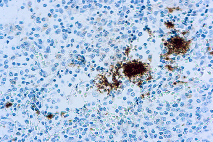 Immunohistochemical staining of CD61/Platelet Glycoprotein IIIa  of human FFPE tissue followed by incubation with HRP labeled secondary and development with DAB substrate.