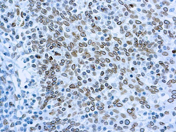 Immunohistochemical staining of Cdc25A  of human FFPE tissue followed by incubation with HRP labeled secondary and development with DAB substrate.