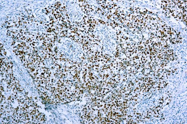Immunohistochemical staining of Cdc47/MCM7  of human FFPE tissue followed by incubation with HRP labeled secondary and development with DAB substrate.