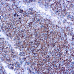 Immunohistochemical staining of CD99  of human FFPE tissue followed by incubation with HRP labeled secondary and development with DAB substrate.