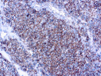 Immunohistochemical staining of CD99  of human FFPE tissue followed by incubation with HRP labeled secondary and development with DAB substrate.