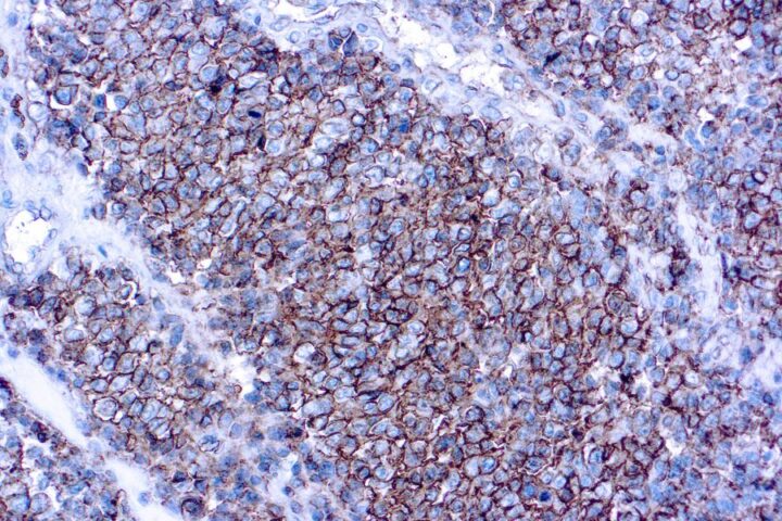 Immunohistochemical staining of CD99  of human FFPE tissue followed by incubation with HRP labeled secondary and development with DAB substrate.