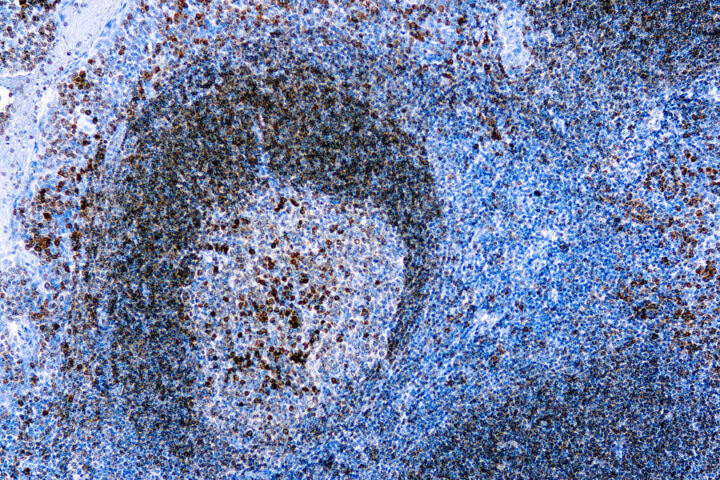 Immunohistochemical staining of CD79a, B Cell  of human FFPE tissue followed by incubation with HRP labeled secondary and development with DAB substrate.