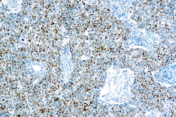 Immunohistochemical staining of Cyclin E Protein  of human FFPE tissue followed by incubation with HRP labeled secondary and development with DAB substrate.