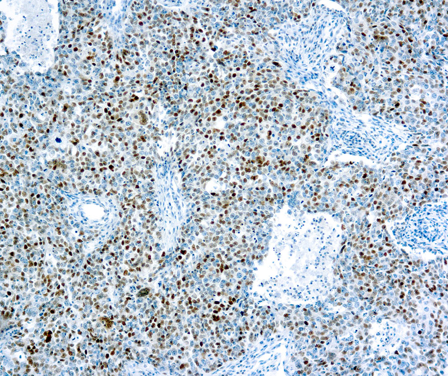 Immunohistochemical staining of Cyclin E Protein  of human FFPE tissue followed by incubation with HRP labeled secondary and development with DAB substrate.