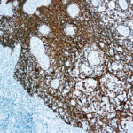 Immunohistochemical staining of Cytokeratin  of human FFPE tissue followed by incubation with HRP labeled secondary and development with DAB substrate.