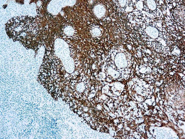 Immunohistochemical staining of Cytokeratin  of human FFPE tissue followed by incubation with HRP labeled secondary and development with DAB substrate.