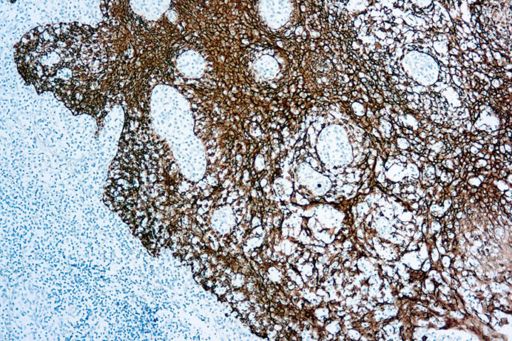 Immunohistochemical staining of Cytokeratin  of human FFPE tissue followed by incubation with HRP labeled secondary and development with DAB substrate.