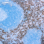 Immunohistochemical staining of Cytokeratin 5/14  of human FFPE tissue followed by incubation with HRP labeled secondary and development with DAB substrate.