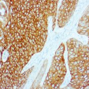 Immunohistochemical staining of Cytokeratin 5/6  of human FFPE tissue followed by incubation with HRP labeled secondary and development with DAB substrate.