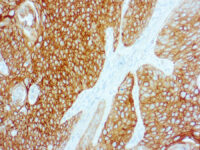 Immunohistochemical staining of Cytokeratin 5/6  of human FFPE tissue followed by incubation with HRP labeled secondary and development with DAB substrate.