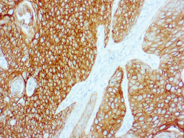Immunohistochemical staining of Cytokeratin 5/6  of human FFPE tissue followed by incubation with HRP labeled secondary and development with DAB substrate.