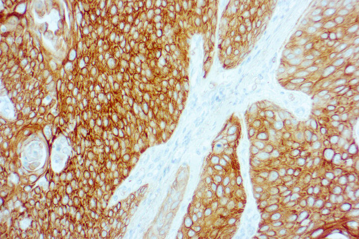 Immunohistochemical staining of Cytokeratin 5/6  of human FFPE tissue followed by incubation with HRP labeled secondary and development with DAB substrate.