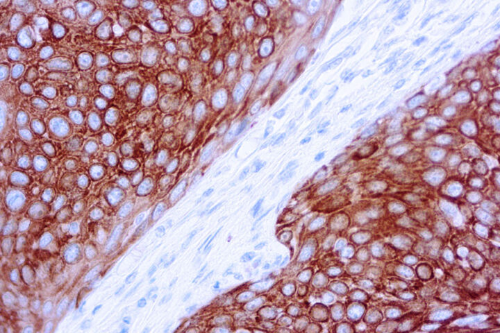 Immunohistochemical staining of Cytokeratin 5/6  of human FFPE tissue followed by incubation with HRP labeled secondary and development with DAB substrate.