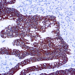 Immunohistochemical staining of Cytokeratin 8/18  of human FFPE tissue followed by incubation with HRP labeled secondary and development with DAB substrate.