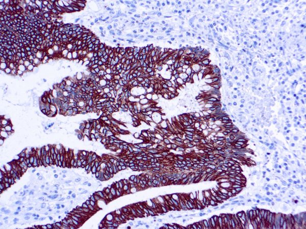 Immunohistochemical staining of Cytokeratin 8/18  of human FFPE tissue followed by incubation with HRP labeled secondary and development with DAB substrate.