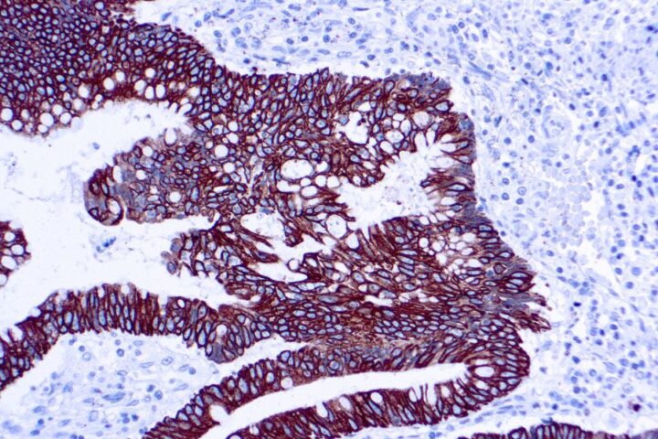 Immunohistochemical staining of Cytokeratin 8/18  of human FFPE tissue followed by incubation with HRP labeled secondary and development with DAB substrate.
