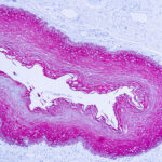 Immunohistochemical staining of Cytokeratin, Wide Spectrum  of human FFPE tissue followed by incubation with HRP labeled secondary and development with DAB substrate.