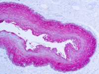 Immunohistochemical staining of Cytokeratin, Wide Spectrum  of human FFPE tissue followed by incubation with HRP labeled secondary and development with DAB substrate.