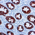 Immunohistochemical staining of Cytokeratin 8, Low Molecular Weight  of human FFPE tissue followed by incubation with HRP labeled secondary and development with DAB substrate.