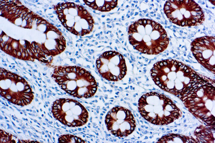 Immunohistochemical staining of Cytokeratin 8, Low Molecular Weight  of human FFPE tissue followed by incubation with HRP labeled secondary and development with DAB substrate.